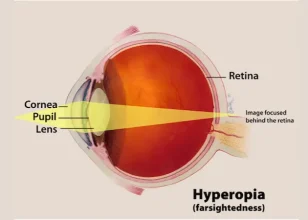 Can Hyperopia Have an Impact on Preschool Early Literacy?