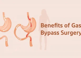 Common Benefits of Gastric Bypass Surgery