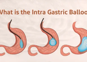 What is the Intra Gastric Balloon?
