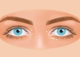 Xanthelasma: Causes, Symptoms, and Treatment