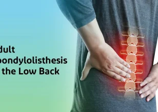 Low Back Spondylolisthesis in Adults: Causes and Treatment