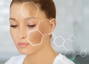 Melasma: Treatment, Causes, and Prevention