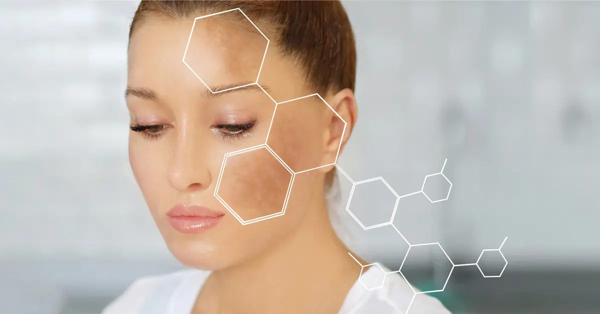 Melasma Treatment, Causes, and Prevention